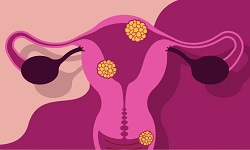 Bacterial vaginosis
